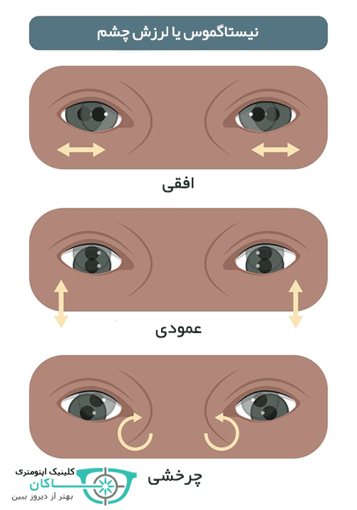 انواع لرزش چشم یا نیستاگموس